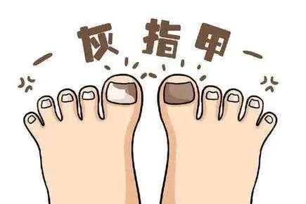 有灰指甲不能办理健康证吗