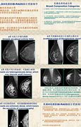 乳腺结节