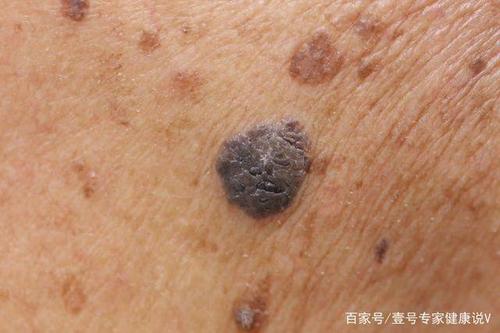 皮肤癌早期症状图片脸上