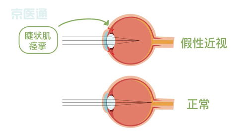 散光的症状严重吗