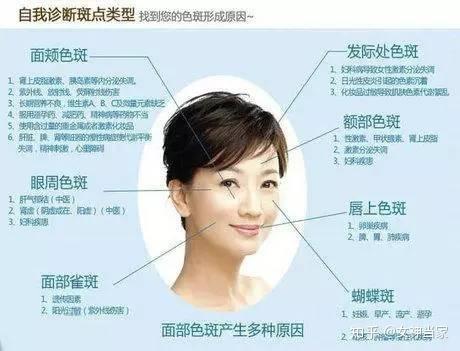 脸颊两侧长斑的原因吃什么药