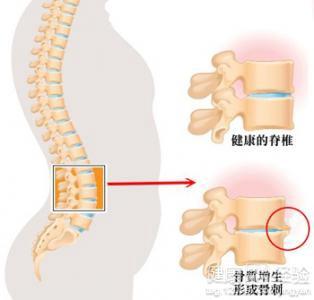 颈椎骨质增生偏方治疗