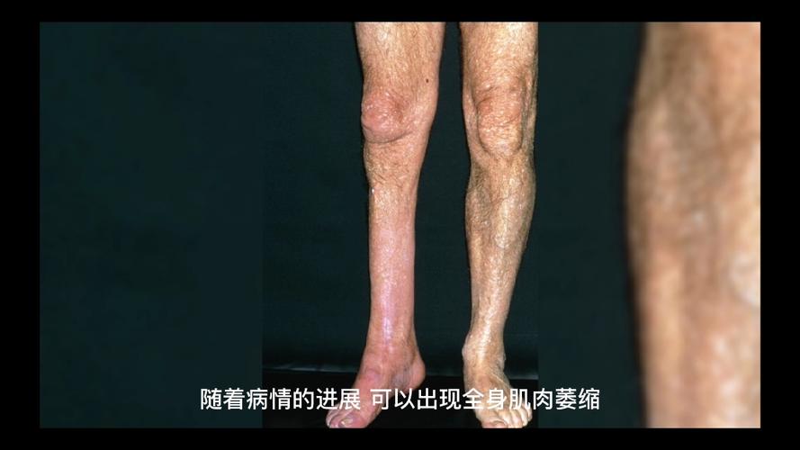 渐冻人早期自测10天